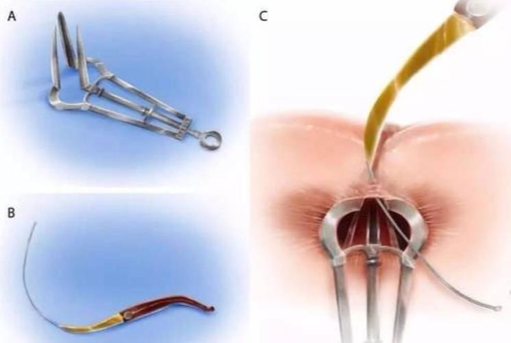 肛瘘的最新治疗方法,肛瘘的最新治疗方法